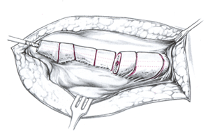 От середины верхней части бедра внешняя полая часть с помощью насадочной сверлильной головки выводится через костномозговой канал в краниальном направлении.
