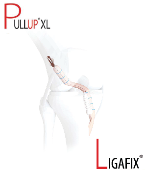 ПКС. Техника «снаружи-внутрь» (PullUP XL + Ligafix)